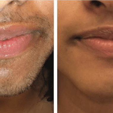 Laser Hair Removal / Lip and Chin at Finalé Hair Removal And Skin Care in Minnetonka, MN